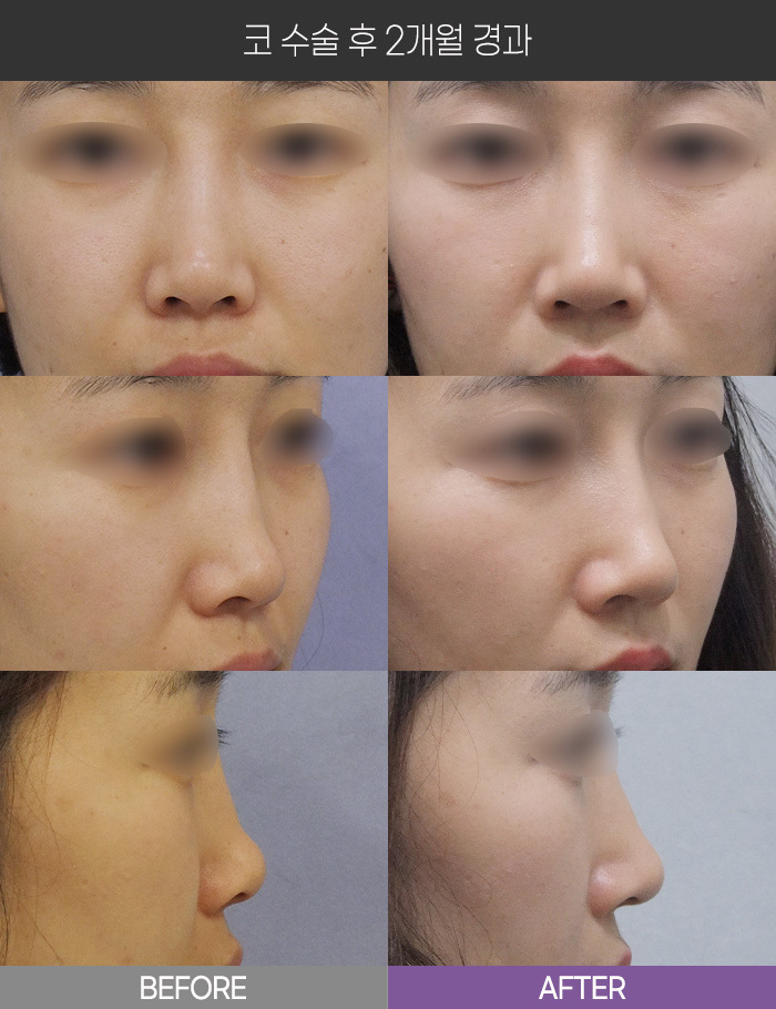 코 수술 2개월 경과