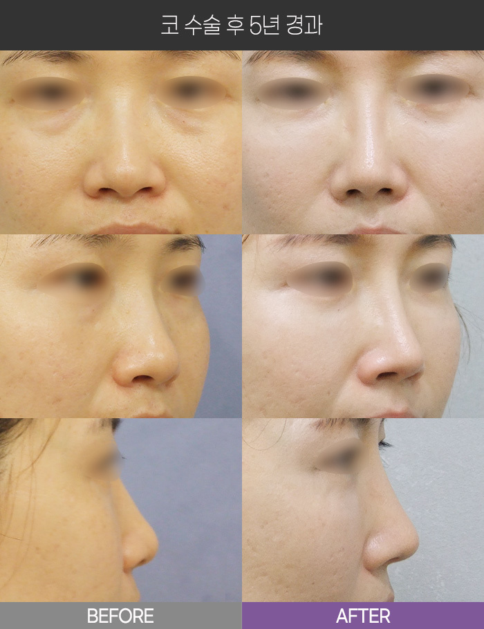 코 수술 5년 경과