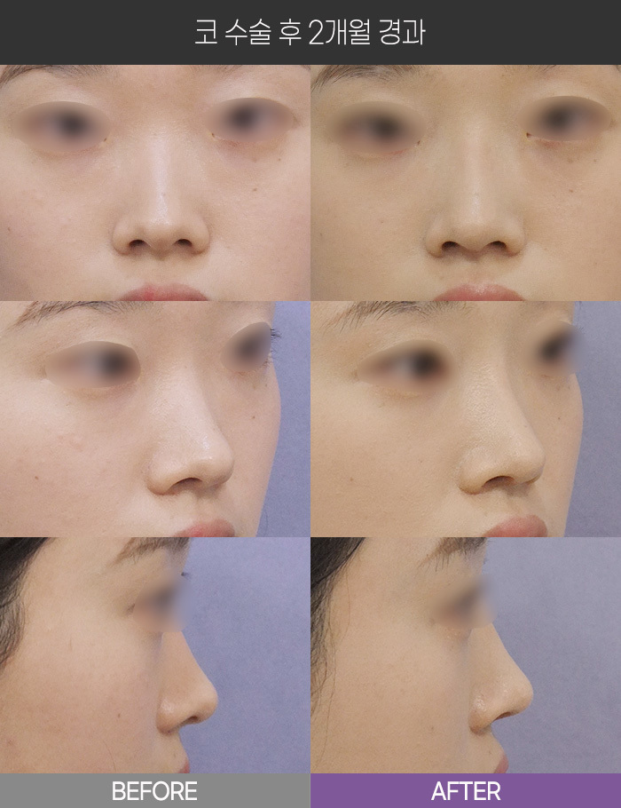 코 수술 2개월 경과