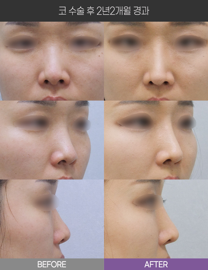 코 수술 2년2개월 경과