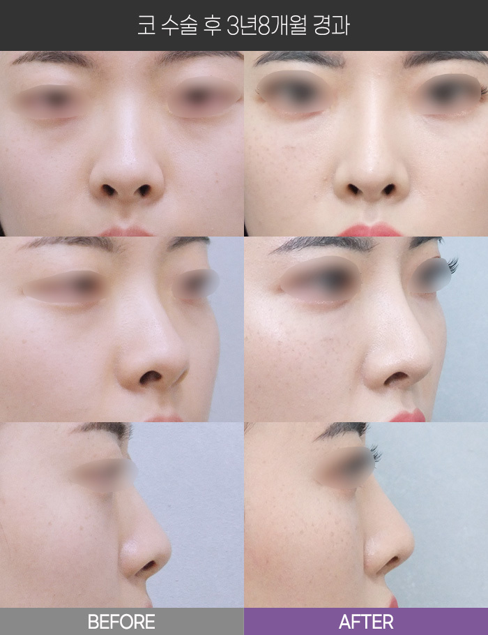 코 수술 3년8개월 경과