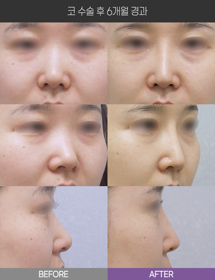 코 수술 6개월 경과