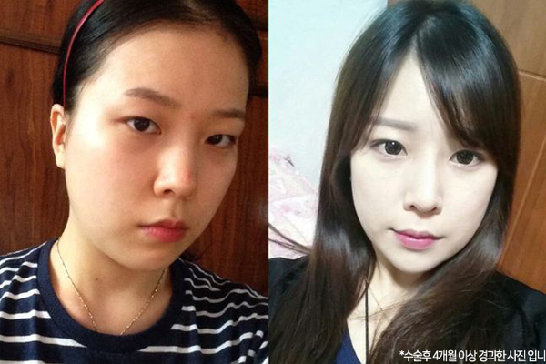 코재수술, 눈수술, 안면지방이식