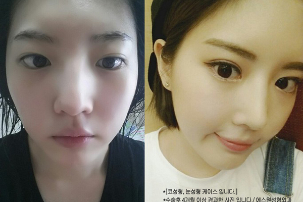 눈코&안면지방이식(이마/턱/광대)