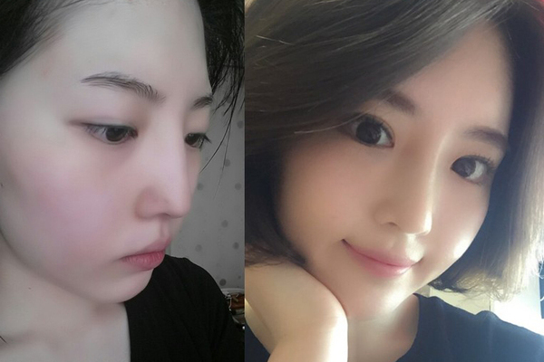눈수술, 코수술, 안면지방이식