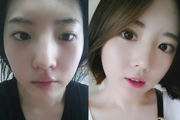 코, 눈, 안면지방이식(이마/턱/광대)