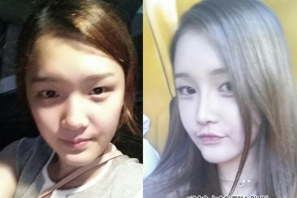 코성형, 눈성형 케이스