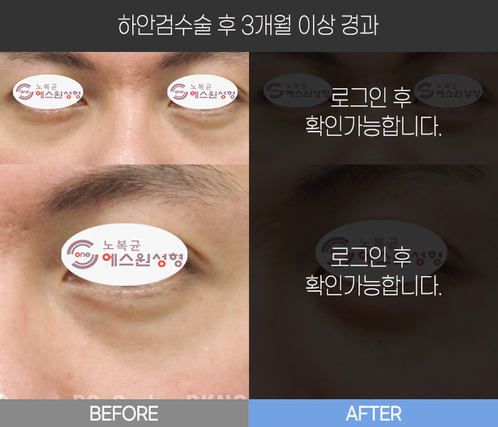 하안검 수술 후  3개월 경과
