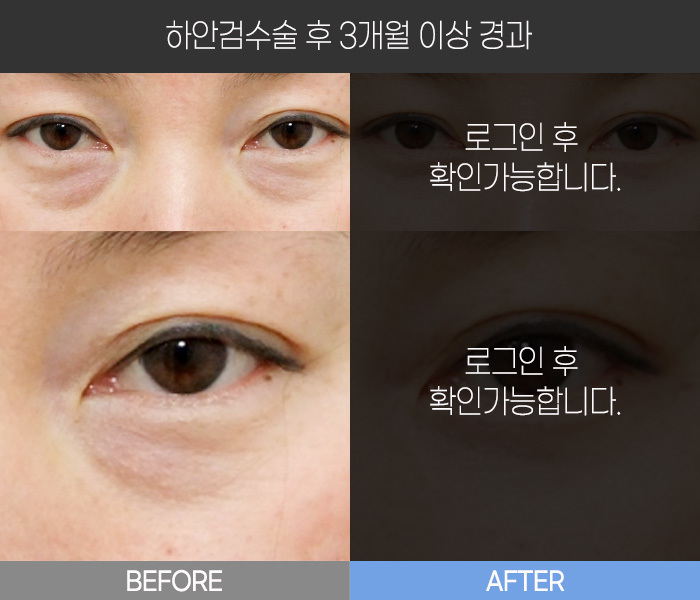 하안검 수술 후  3개월 경과