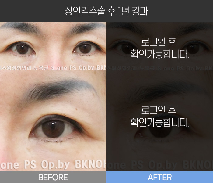 상안검 수술 후 1년 경과