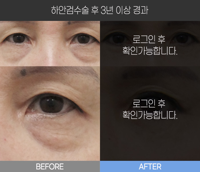 하안검 수술 후  3년 경과