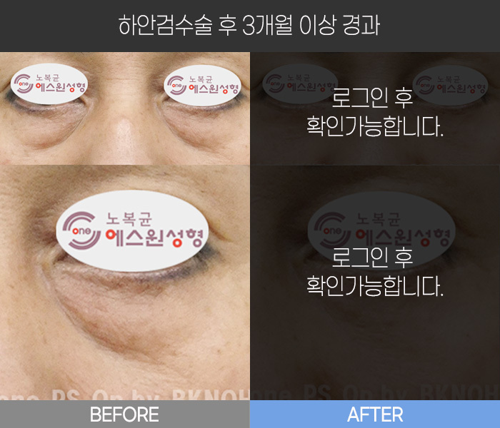 하안검 수술 후  3개월 경과