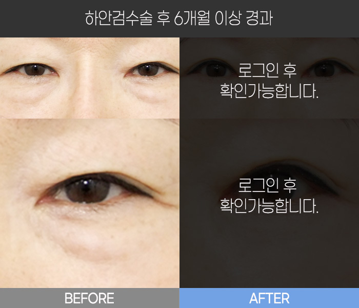 하안검 수술 후  6개월 경과