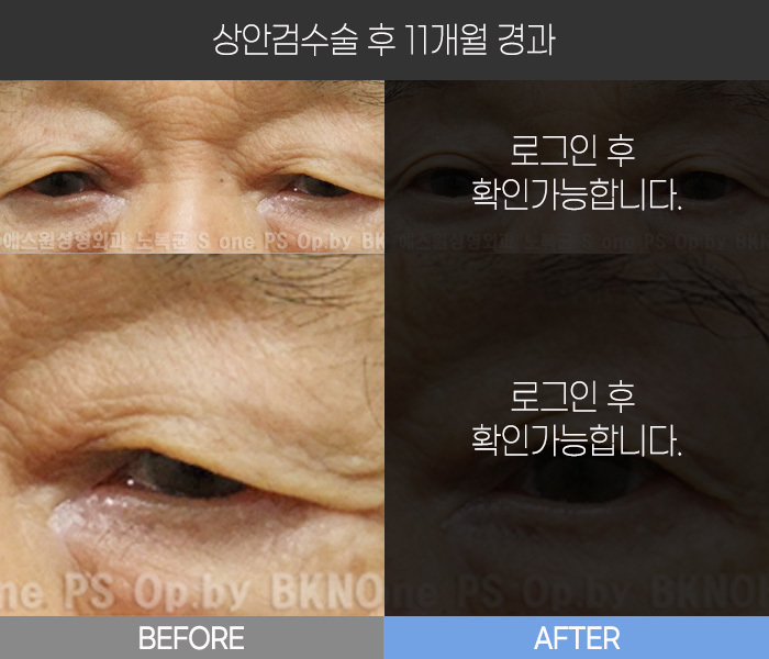 상안검 수술 후 11개월 경과