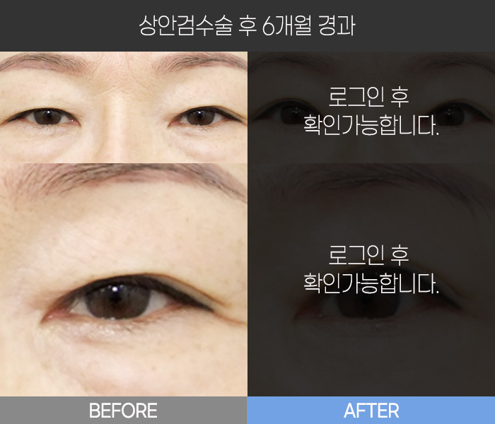 상안검 수술 후 6개월 경과