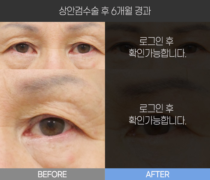 상안검 수술 후 6개월 경과