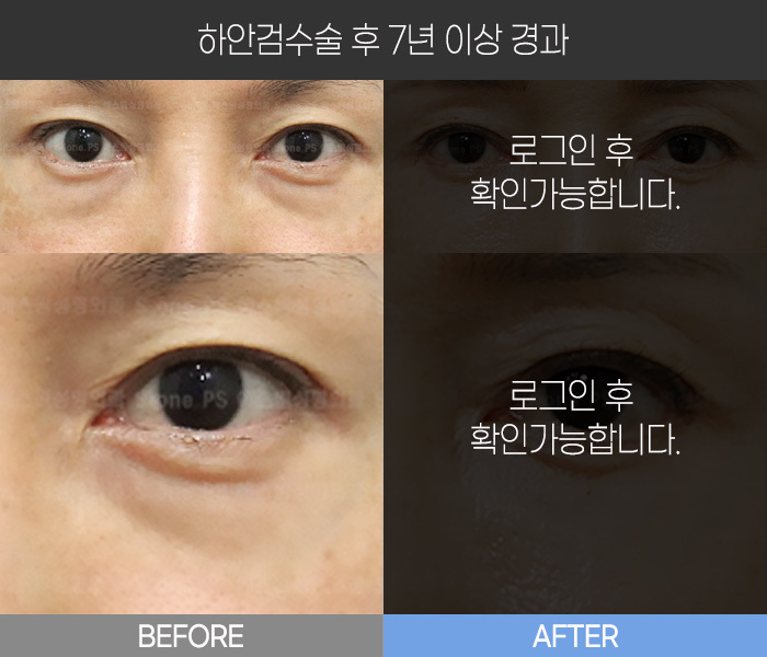 하안검 수술 후 7년 경과