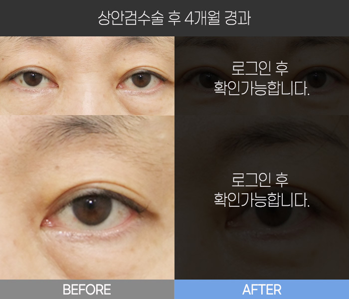 상안검 수술 후 4개월 경과