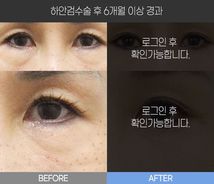 하안검 수술 후  6개월 경과