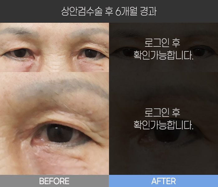 상안검 수술 후 6개월 경과