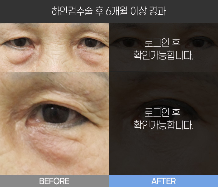 하안검 수술 후  6개월 경과
