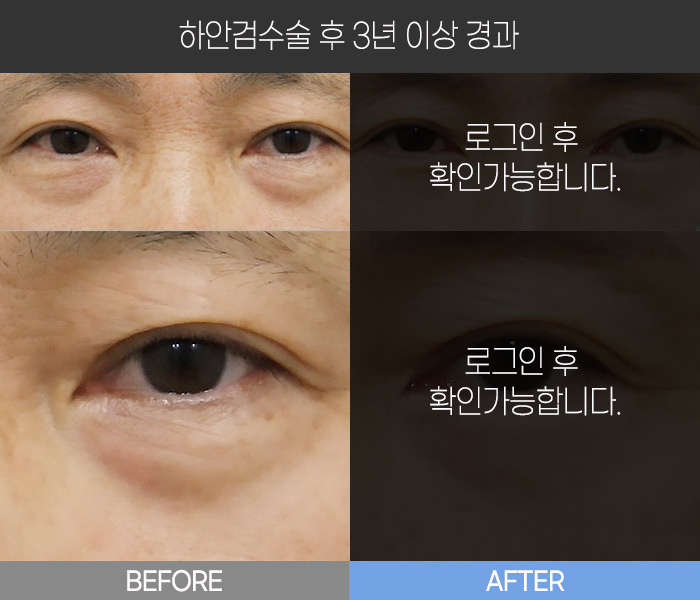 하안검 수술 후  3년 경과