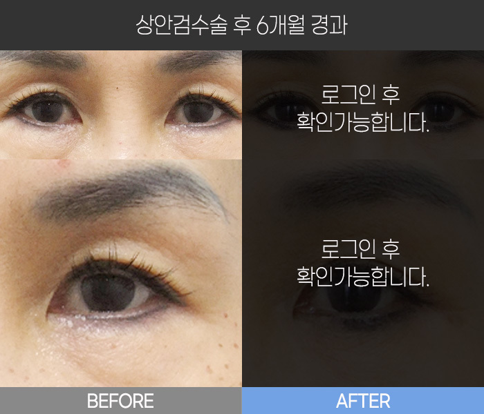 상안검 수술 후 6개월 경과