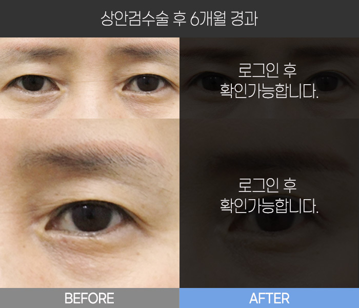 상안검 수술 후 6개월 경과