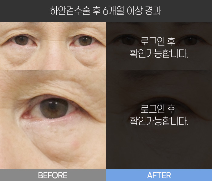 하안검 수술 후  6개월 경과