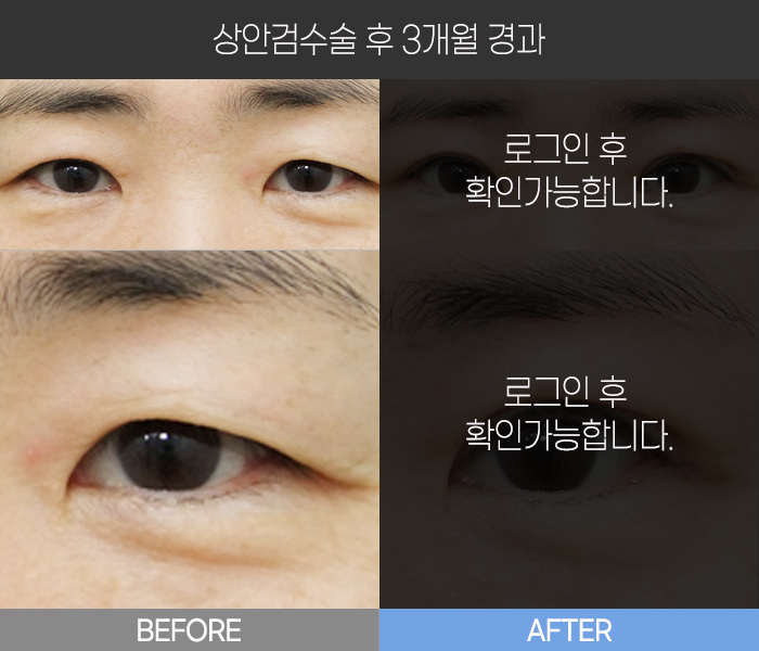 상안검 수술 후 3개월 경과