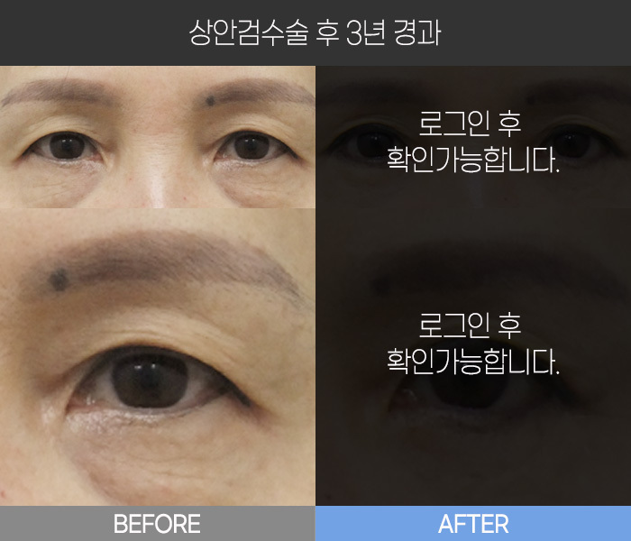 상안검 수술 후 3년 경과