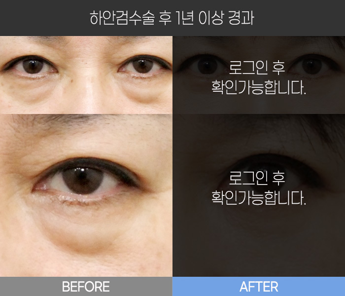 하안검 수술 후  1년 경과