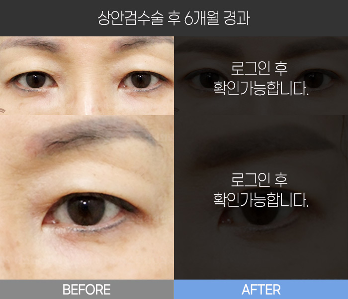 상안검 수술 후 6개월 경과