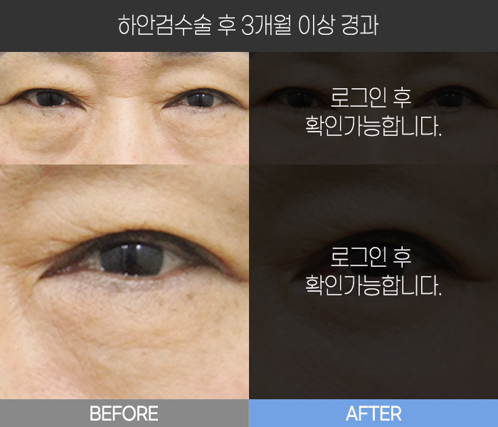 하안검 수술 후  3개월 경과