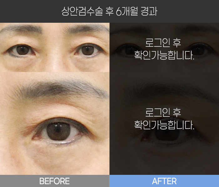 상안검 수술 후 6개월 경과