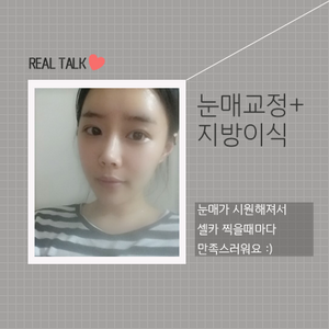 눈매교정+지방이식