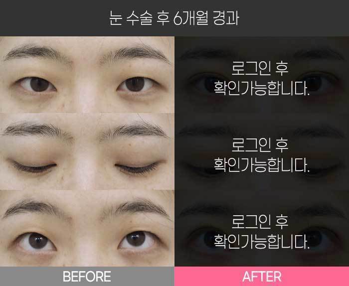 눈 수술 후 6개월 경과