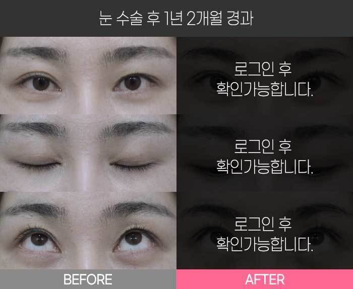 눈 수술 후 1년 2개월 경과