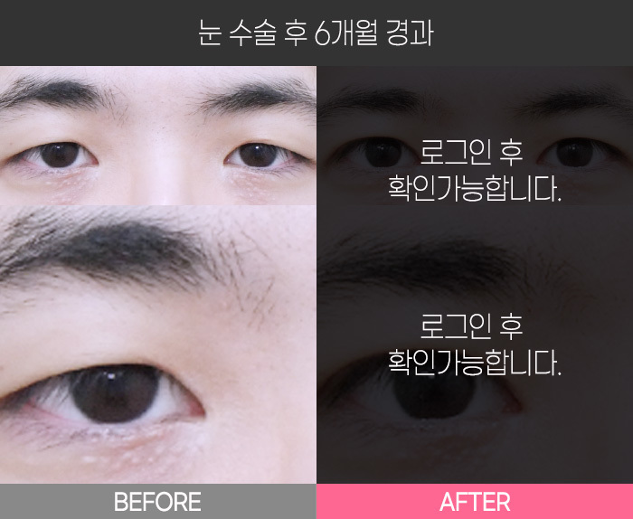 눈 수술 후 6개월 경과