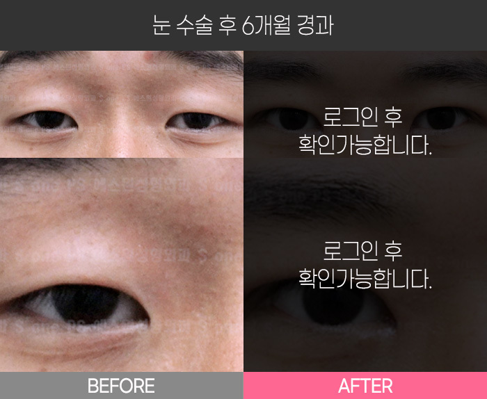 눈 수술 후 6개월 경과