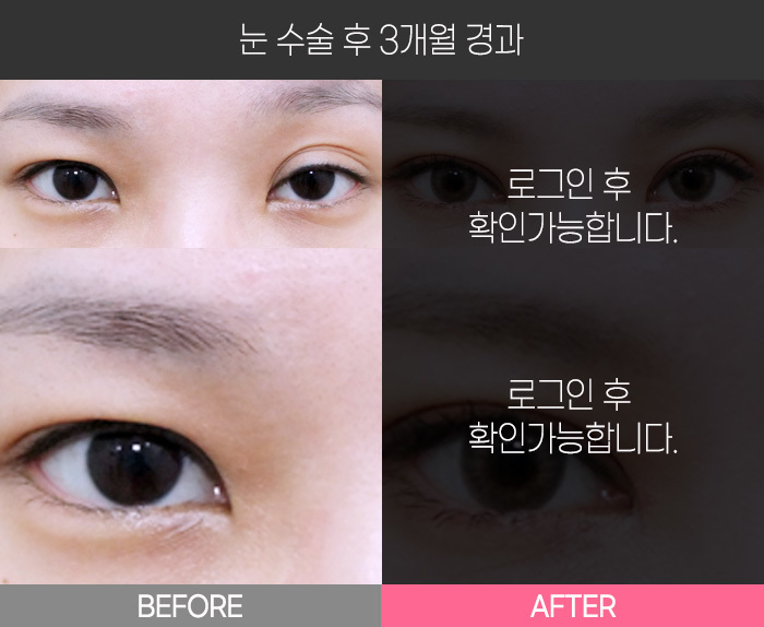 눈 수술 후 3개월 경과