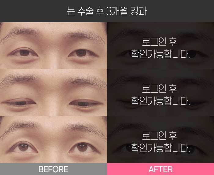 눈 수술 후 3개월 경과