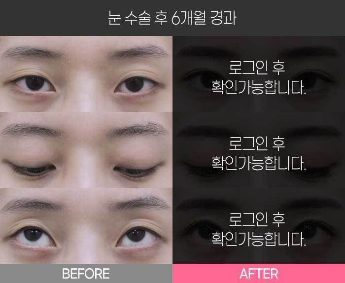 눈 수술 후 6개월 경과