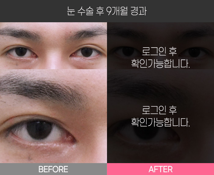 눈 수술 후 9개월 경과