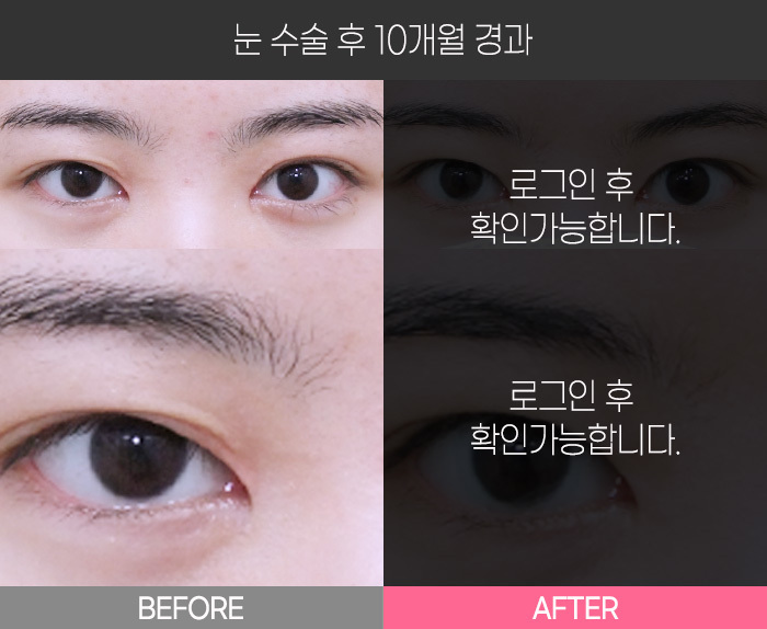 눈 수술 후 10개월 경과