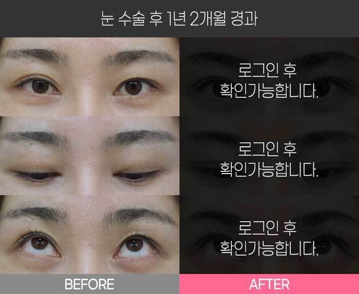 눈 수술 후 1년 2개월 경과