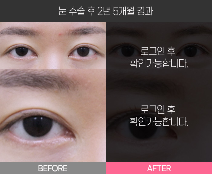 눈 수술 후 2년  5개월 경과