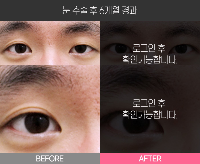 눈 수술 후 6개월 경과