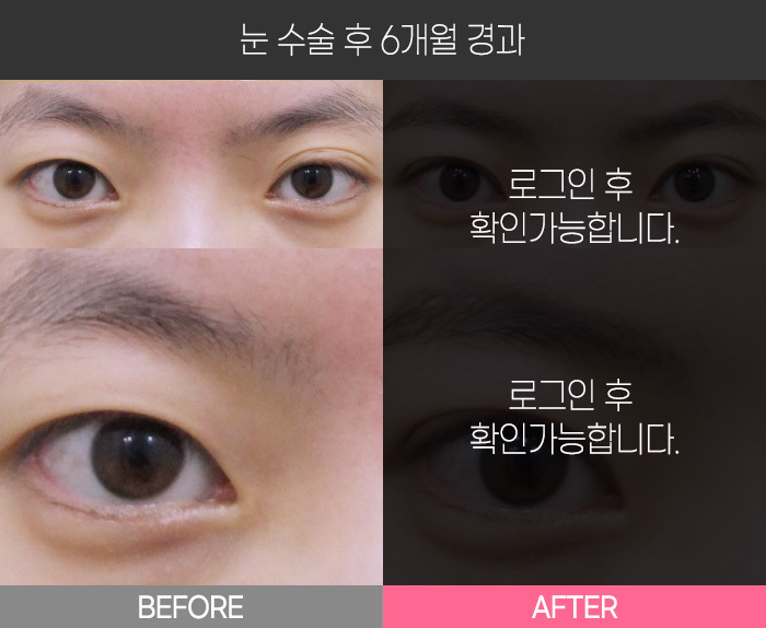 눈 수술 후 6개월 경과