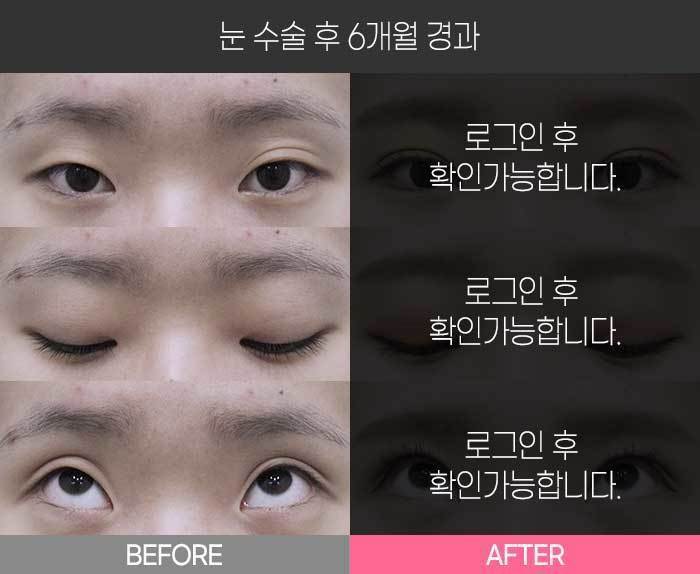 눈 수술 후 6개월 경과